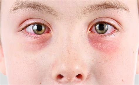 conjuntivitis en niños - manchas rojas en la piel